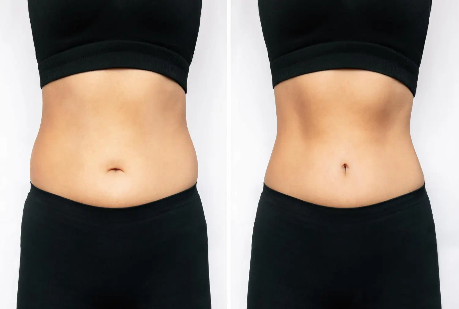 CoolSculpting vs. Liposuction: AE.R Skinlab