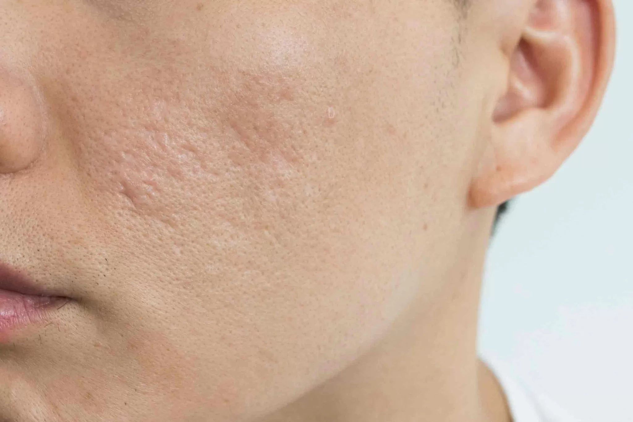 Acne & Scar Treatment in Vancouver