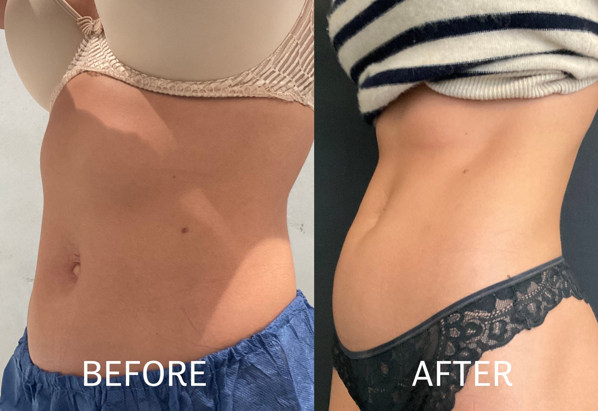 Ozempic for Weight-loss