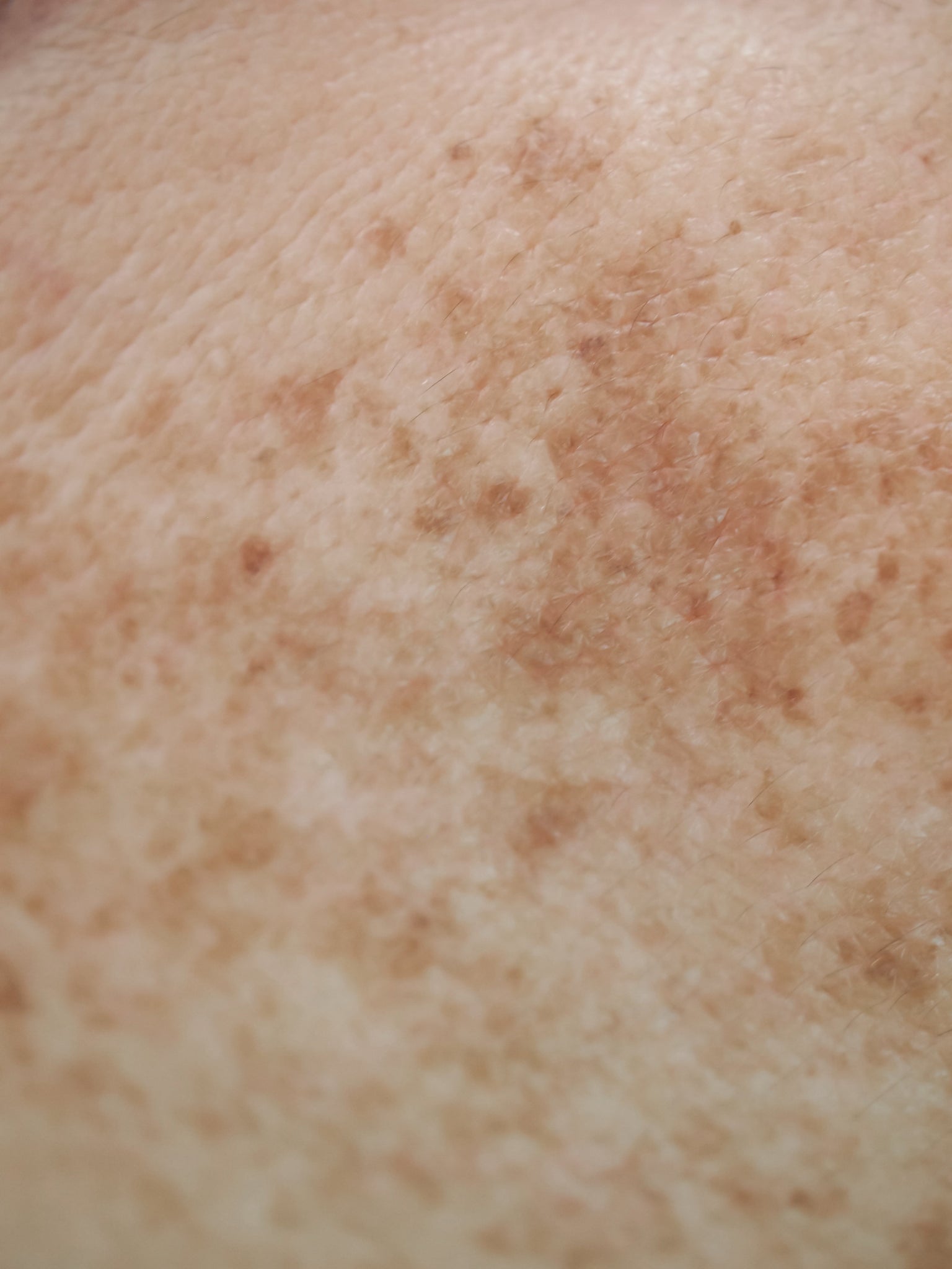 Let's talk about Pigmentation!