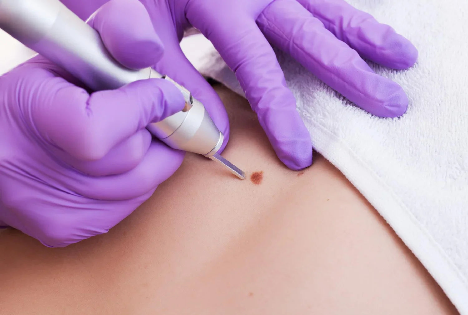 Cherry Angioma: You Might be Living With It. Should You Remove It or Live With It?