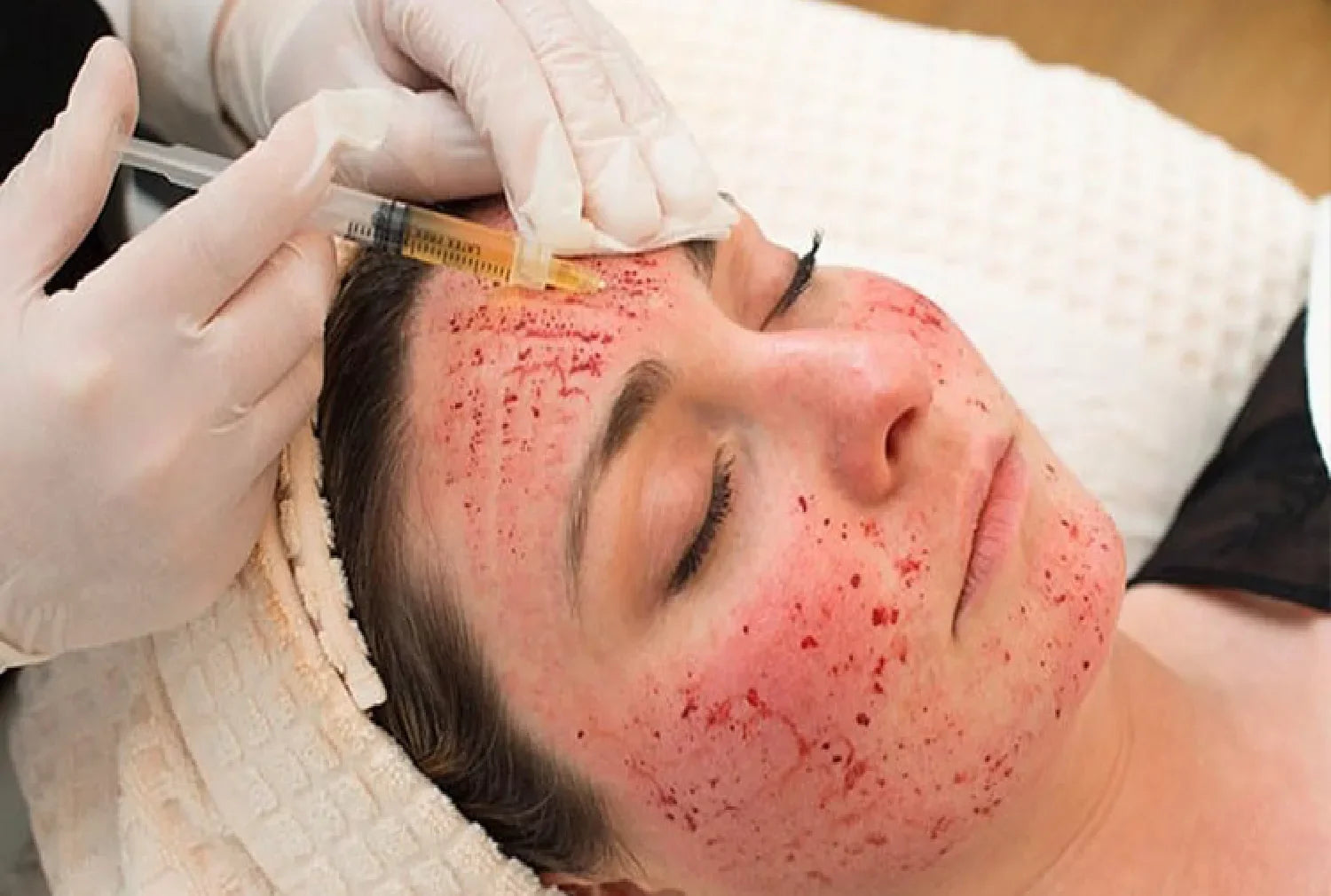 What Is a Vampire Facial and Why Is It So Popular?