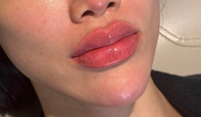 Best Lip Injections Vancouver | Russian Lip Filler Technique - AE.R Skinlab