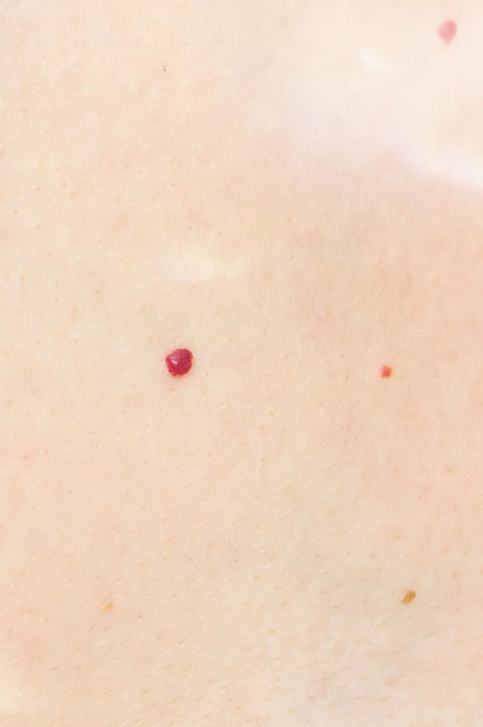 Cherry Angioma